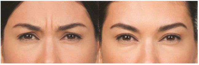 Botox patient before and after photo