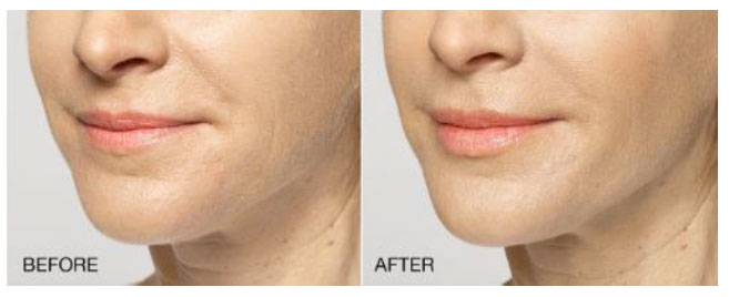 patient before and after results for Restylane Silk
