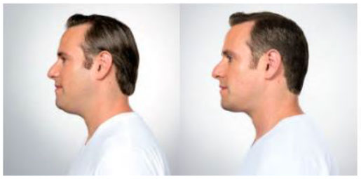 Before & after male patient results for Kybella procedure