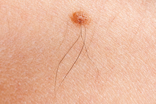 macro shot of melanoma with hairs on woman skin