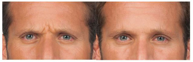 Botox patient before and after photo