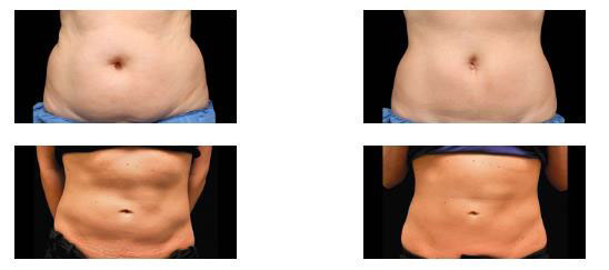 CoolSculpting patient before and after photos.