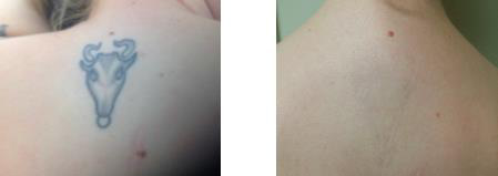 Patient reveals before and after photos of laser tattoo removal results
